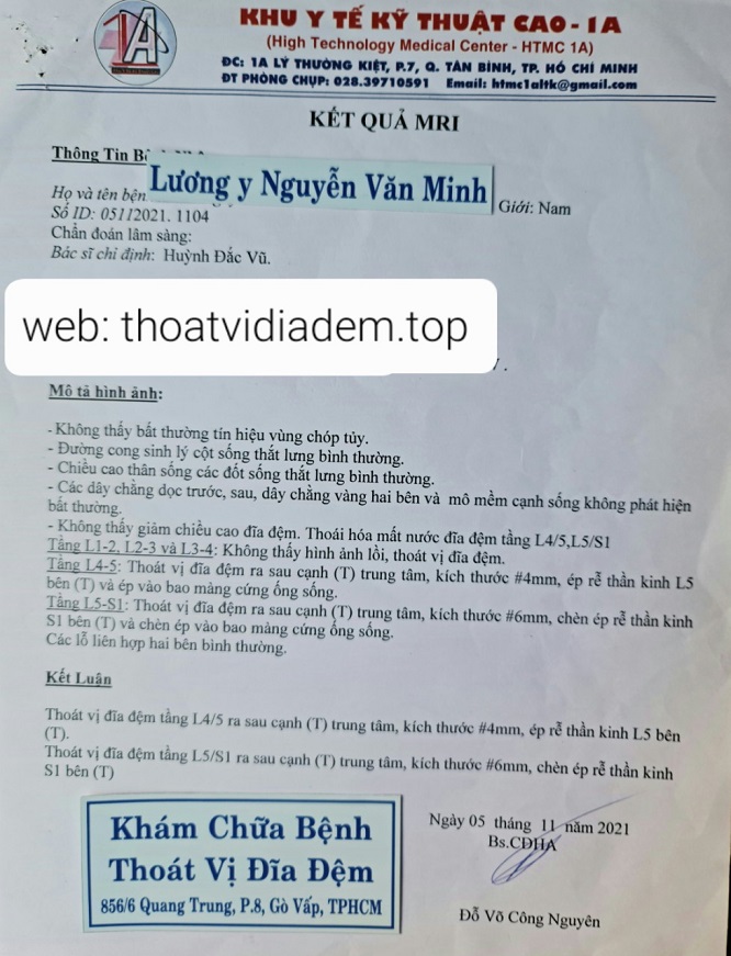 Thoát vị đĩa đệm bên trái